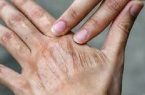 اقدام ساده برای رفع خشکی پوست اقدام ساده برای رفع خشکی پوست