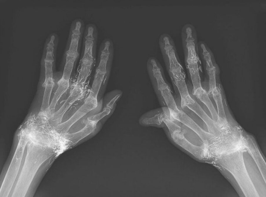 کشف صدها رشته طلای خالص در زانوی زن مبتلا به آرتروز